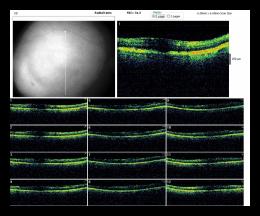 RADIAL LINE OD